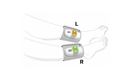 Bluetooth Blood Pressure Cuff for TBI / ABI Testing